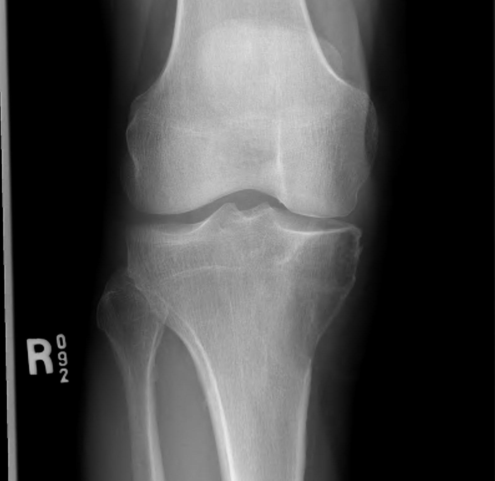 Proximal Tibial Lytic Epiphyseal Lesion Xray